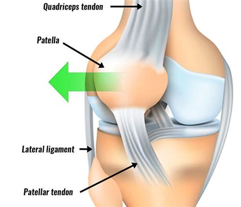 Acute Kneecap Dislocation Carolinas Pain Center