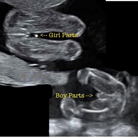 20 Week Ultrasound Archives Peanut Mom