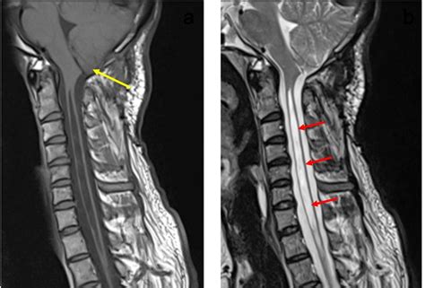 Arnold Chiari Malformation With Syringohydromyelia Radiology Cases