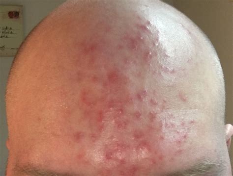 Acne On Forehead General Acne Discussion Forum