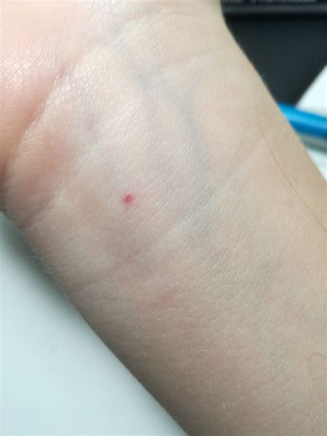 what could cause these red spots to continuously develop on my hands photo human