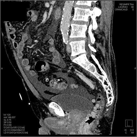 Rectal Varices And Cirrhosis Of The Liver In Gi Bleed Patient Colon