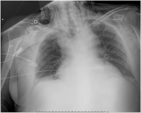 Ap Chest X Ray Shows Widened Mediastinum Download Scientific Diagram