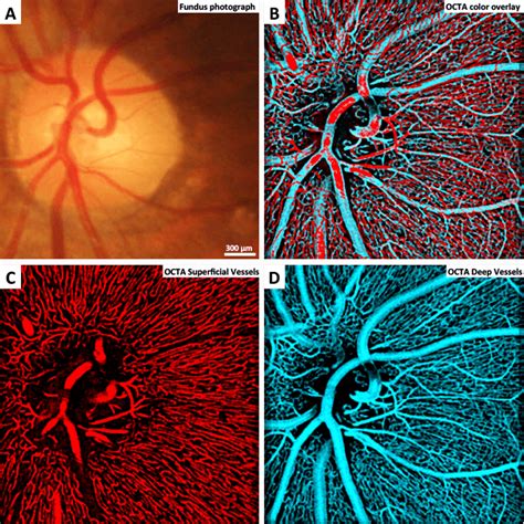 The Art Of Eyes Untold Ophthalmology The Ophthalmologist