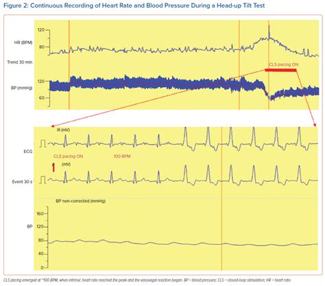 Continuous Recording Of Heart Rate And Blood Pressure During A Head Up