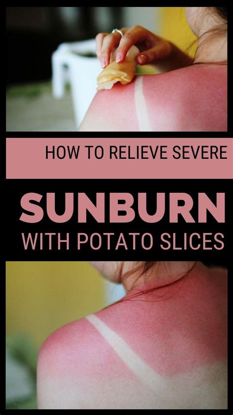 How To Relieve Severe Sunburn With Potato Slices Webmd Abc Severe