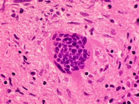 Giant Cells Giant Cells Multinucleated Multinucleated Giant Cells