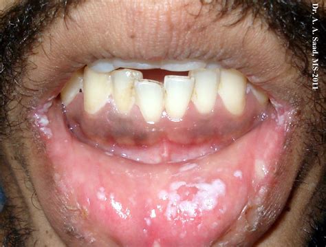 Candidiasis Oral Dermrounds Dermatology Network