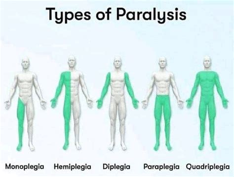 Why Does Paralysis Occur Quora