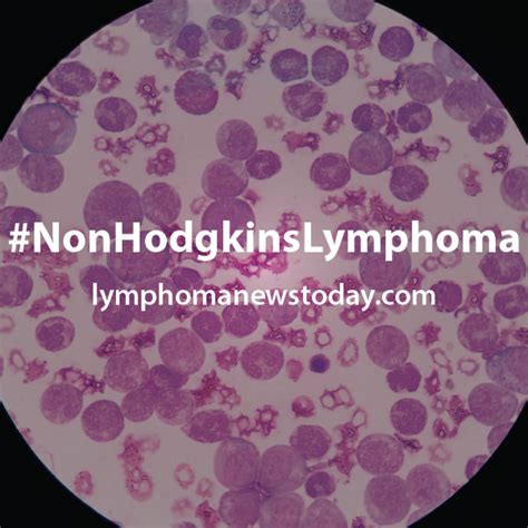 Looking For Information On Non Hodgkins Lymphoma Non Hodgkins