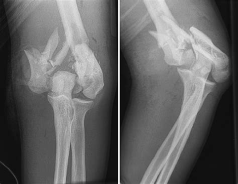 Distal Humerus Fractures Hand Clinics