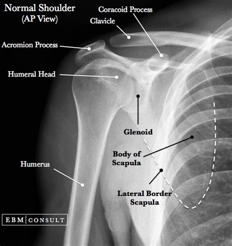 Shoulder X Ray Ap View Radiology Radiology Imaging Medical Anatomy