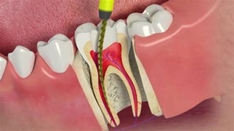 Root Canal Therapy All You Need To Know Muna Dental Clinic