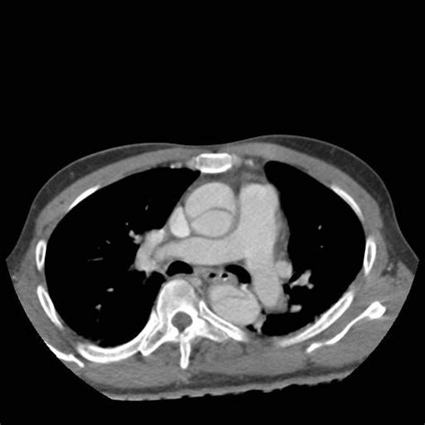 Angio Ct Showing Aortic Dissection Radrounds Radiology