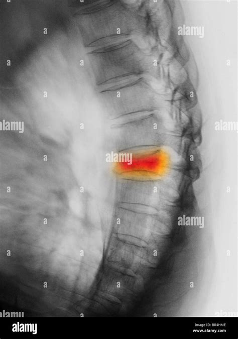Dorsal Spine X Ray In Lateral View Showing A T7 Compression Fracture In