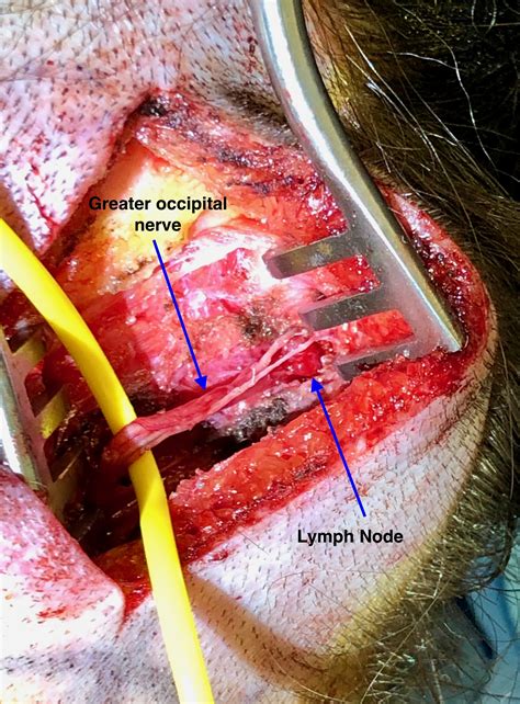 Occipital Nerve Decompression Photos Migraine Surgery Specialty Center