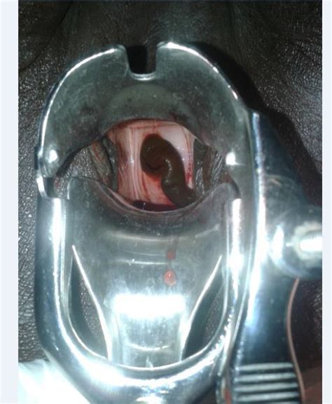 Speculum Exam Showing Leech Attached To Cervical Of A 70 Year Old Woman Download Scientific