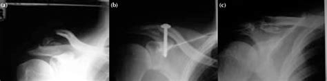 Radiographs Showing A Neer Type Ii Displaced Distal Clavicle