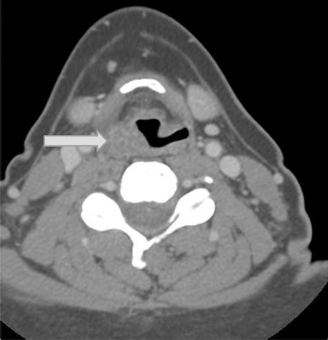An Axial Contrast Enhanced Ct Scan Of The Neck A A Right Sided Level