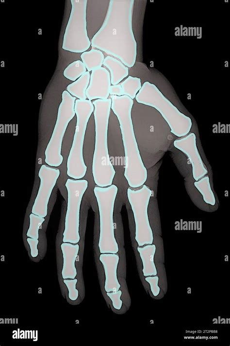 Healthy Hand X Ray Stock Photo Alamy