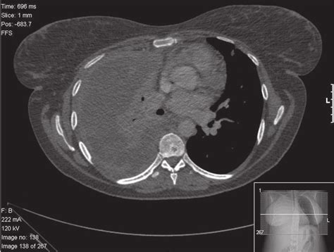 Ct Scan Demonstrating Pleural Thickening Effusion Right Lung Collapse