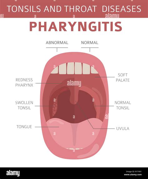 Tonsils And Throat Diseases Pharyngitis Symptoms Treatment Icon Set Medical Infographic