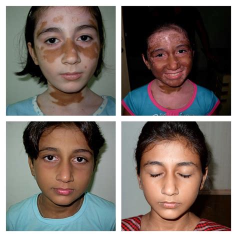 Awesome Results Maharshi Vitiligo Centres Indias Largest Vitiligo