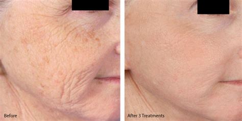 Microneedling Before And After Gallery Md Needle Pen