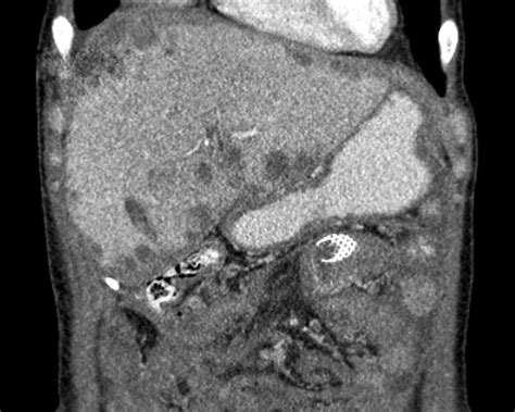 Liver Atlas Diagnosis Metastasis Ovarian Cancer