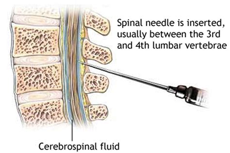 Lumbar Puncture Procedure Position And Lumbar Puncture Side Effects