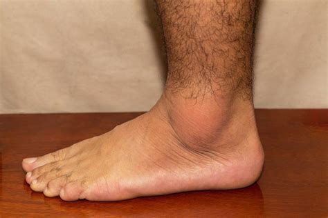 Early Onset Gout May Be Associated With Increased Cardiovascular