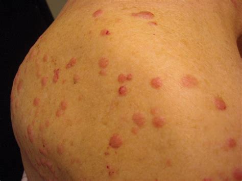 Multiple Firm Pink Papules And Nodules Mdedge Dermatology