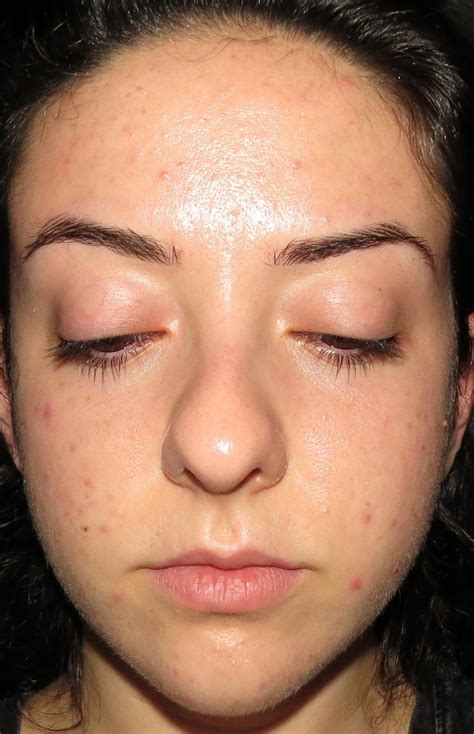 My Skins Journey Banish Acne Scars Vitamin C Beauty Elixir