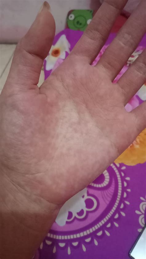 Bintik Merah pada Kulit, Kenali 10 Penyebabnya - Hello Sehat