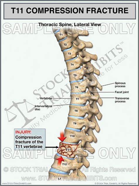 T11 Compression Fracture Of The Thoracic Spine Stock Trial Exhibits