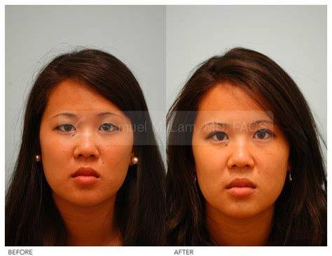 Asian Blepharoplasty Photo Female Asian Blepharoplasty Double Eyelid Surgery By Dr Samuel