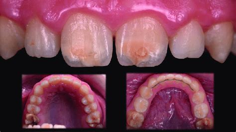 Young Patient With Lesions Of Molar Incisor Hypomineralization Mih On
