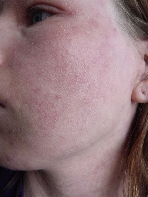 I Have Eczema Photo Of Eczema Skin 5 Months Topical Steroid Withdrawal