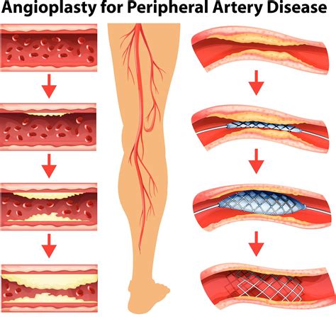 Pta Stent And Atherectomy In Lafayette La Restore Blood Flow And