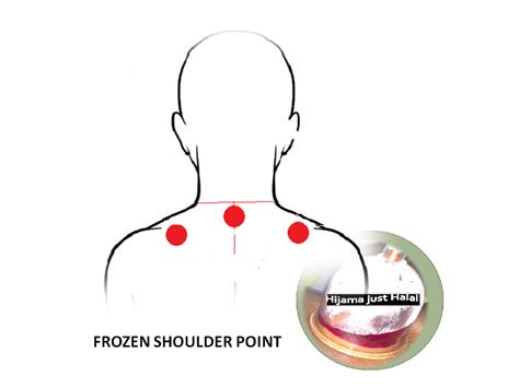 Frozen Shoulder Back Points Cupping Points Hijama Cupping Fire Cupping Cupping Therapy