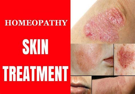 Kesula Clinic Permanent Treatment For Fungal Infection