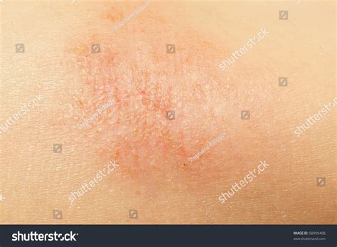 Macro Of Eczema On Little Girl Arm Skin Stock Photo 58999408 Shutterstock