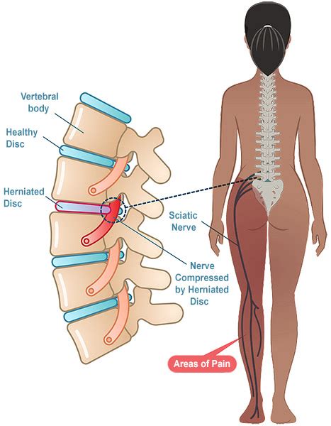 The Difference Between Bulging Disc And Herniated Disc Off