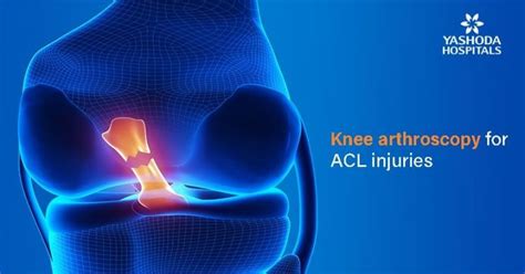Anterior Cruciate Ligament Tear Acl Injuries Symptoms Diagnosis And Treatment