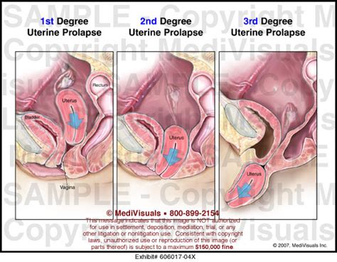 3 Degrees Of Uterine Prolapse Medical Illustration Medivisuals