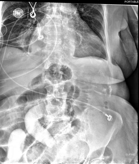 Paralytic Ileus