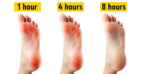 How To Get Rid Of Blisters On Feet Naturally Beauty2natural