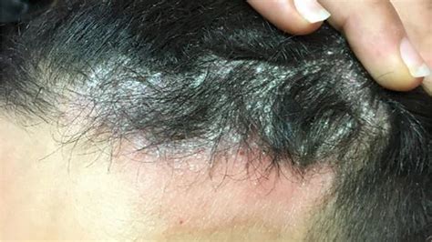 What Deficiency Causes Scalp Psoriasis 27f Chilean Way