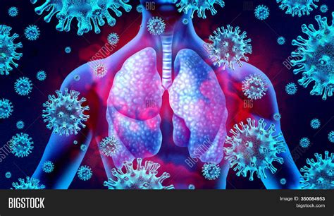 Lung Virus Infection Image And Photo Free Trial Bigstock