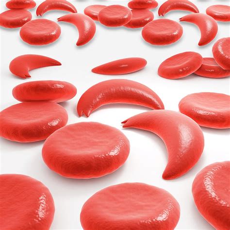 Red Blood Cells In Sickle Cell Anaemia Photograph By Pixologicstudio